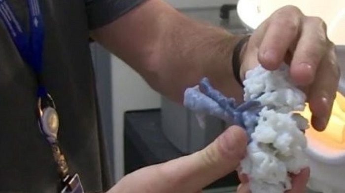 Doctors use 3-D printed kidney to help save woman`s organ 